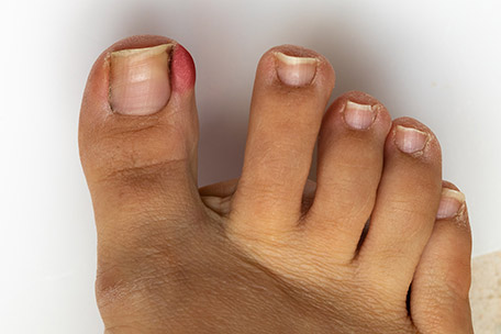 Diabetic Foot Care - King of Prussia