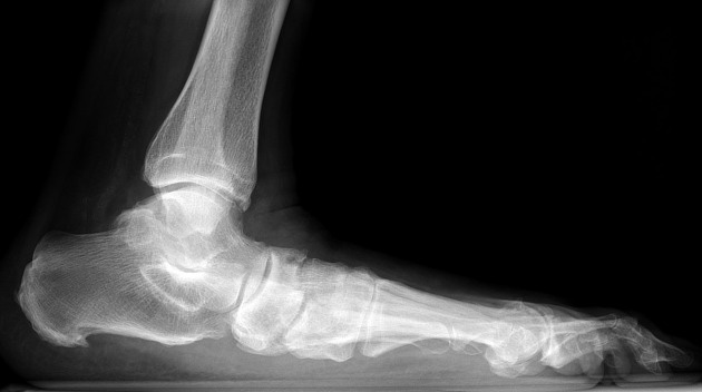 flatfoot Weight-bearing side-view X-ray used to check whether the arch is collapsing in flatfoot