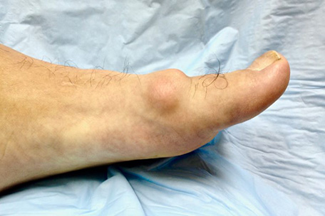 BigToeArthritis2 Foot Arthritis