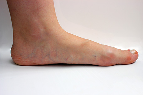 FlatfootSide2 Sports Injuries - King of Prussia
