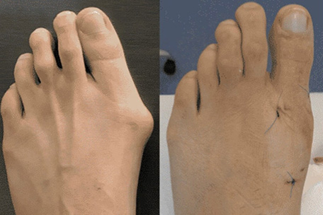 MISFootSurgery Diabetic Foot Care - King of Prussia