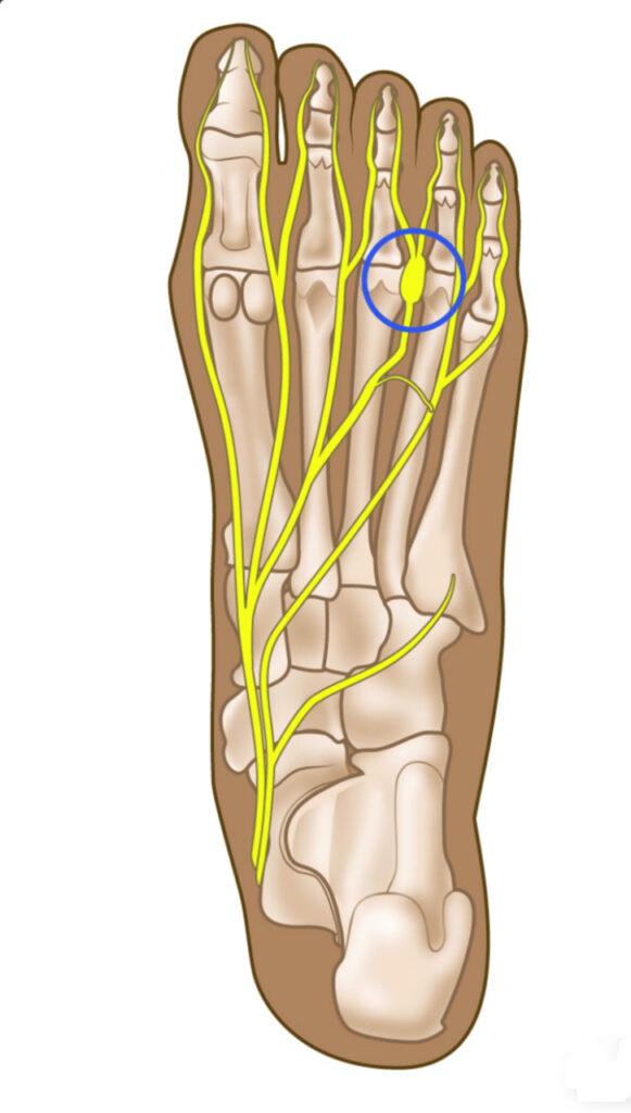 Foot Neuroma