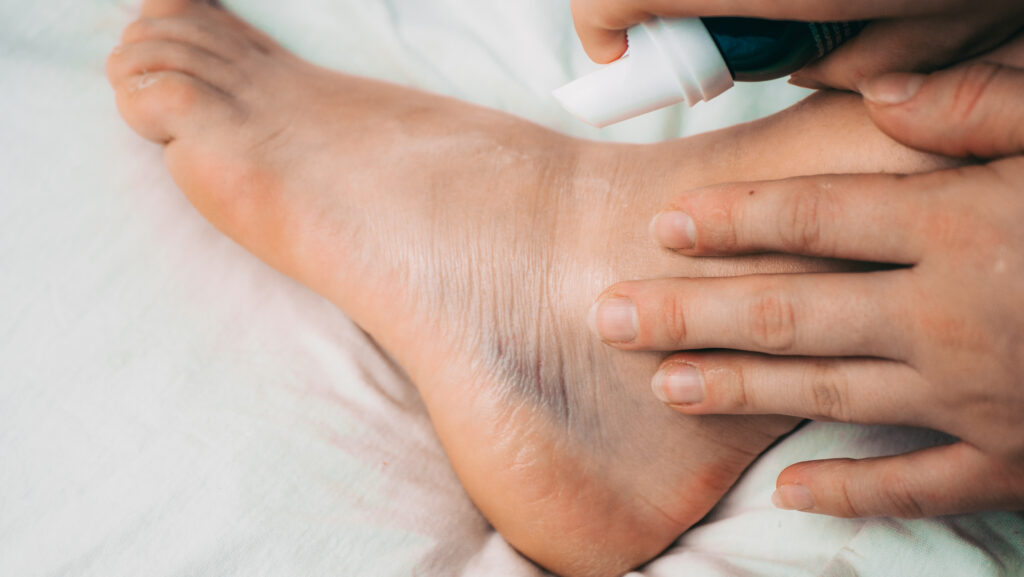 AnkleBruise Ankle Sprain Possible Fracture